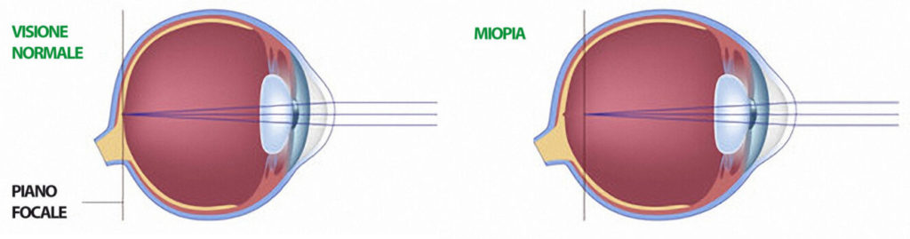 Miopia